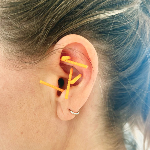 Øreakupunktur i Hvidovre nær København hos Løvendahl terapi